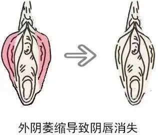 外阴白斑是属于哪种类型的疾病?