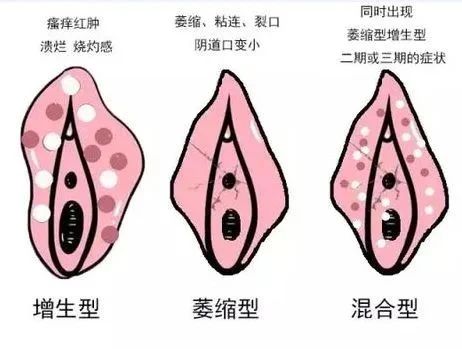 外阴白斑的早期症状都有哪些?