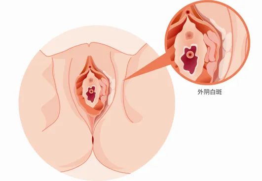 外阴白斑是属于哪种类型的疾病?