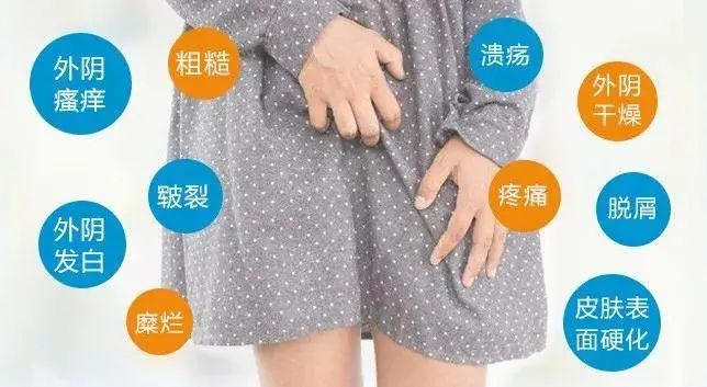 为什么外阴白斑导致的外阴瘙痒越来越严重?