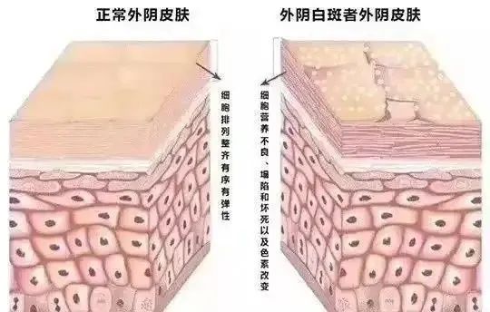 自行使用激素药膏到底能不能治好外阴白斑呢?
