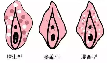 为什么外阴白斑确诊都是中晚期了?